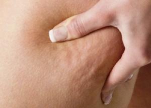 Супрун рассказала, как нужно бороться с целлюлитом