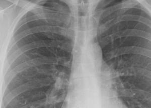 В Украине количество выявленных случаев туберкулеза сократилось на 30%
