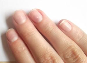 Врачи назвали неожиданные признаки диабета, которые видно на ногтях