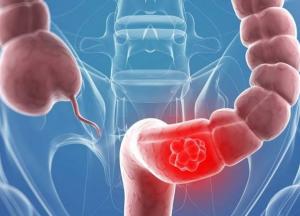 Медики назвали главный предупреждающий симптом рака кишечника