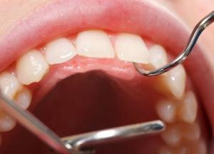 Назван самый необычный симптом диабета