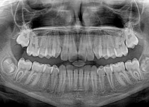 Ученые нашли в организме человека ранее неизвестные слюнные железы 