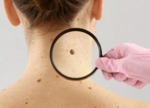 Врачи раскрыли первые признаки рака кожи