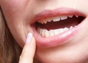 Эксперты назвали народные методы лечения язв во рту