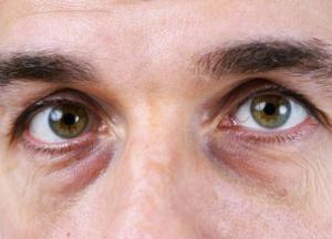 Медики рассказали, как избавиться от мешков под глазами