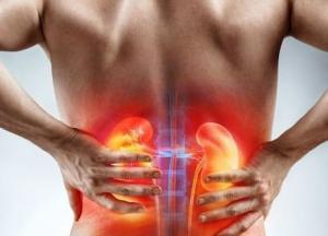 Врачи рассказали, как предупредить образование камней в почках 