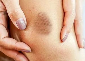 Врач объяснил, на какую проблему указывает внезапное появление синяков