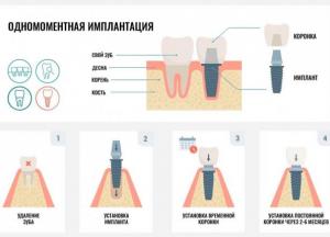Одномоментная имплантация зубов: показания и противопоказания