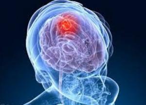 Врачи рассказали о главных симптомах рака головного мозга