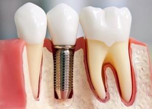 Мифы имплантации зубов
