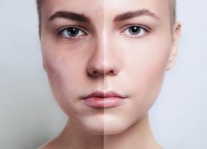 Лазерная шлифовка: все, что нужно знать о процедуре