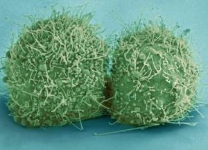 Медики выявили необычное состояние организма при возникновении рака