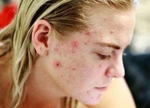Названы продукты, провоцирующие прыщи и угри на лице