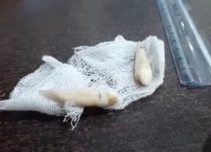 В Индии стоматолог удалил самый длинный в мире человеческий зуб