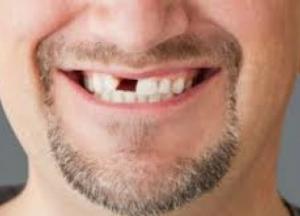 Количество выпавших зубов расскажет, сколько осталось жить: исследование ученых