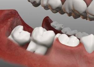 Стоматологи рассказали всю правду о зубах мудрости 