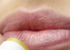 Почему возникают заеды и как их лечить