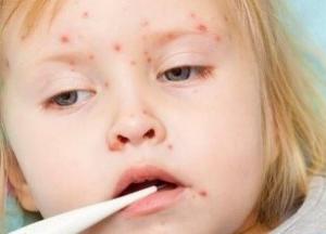 " Конкурент коронавирусу" на Закарпатье с менингококковой инфекцией госпитализировали 10 детей
