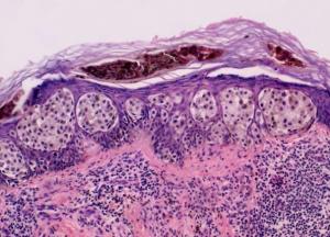 Медики рассказали, как определить риск меланомы до первых симптомов 