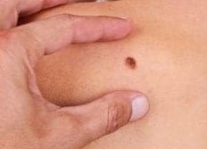 Онкологи назвали главный симптом рака кожи 