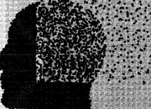 Ученые разгадали загадку болезни Паркинсона