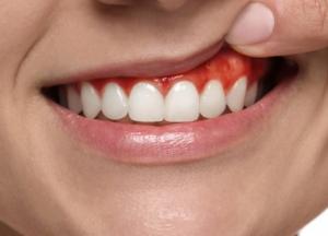 Гінгівіт: як захистити свої ясна від запалення