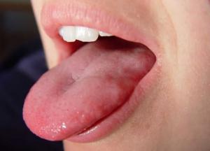 Стоматологи рассказали, о каких заболеваниях может рассказать состояние языка